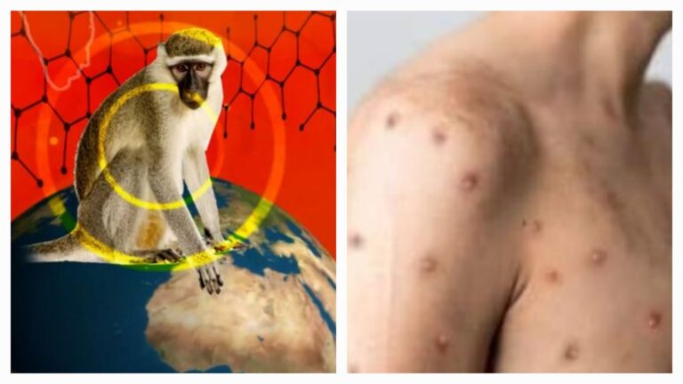 मंकीपॉक्स अलर्ट (Monkeypox alert): स्वास्थ्य मंत्री डॉ0 धनसिंह रावत के निर्देश पर विभाग ने जारी की SOP