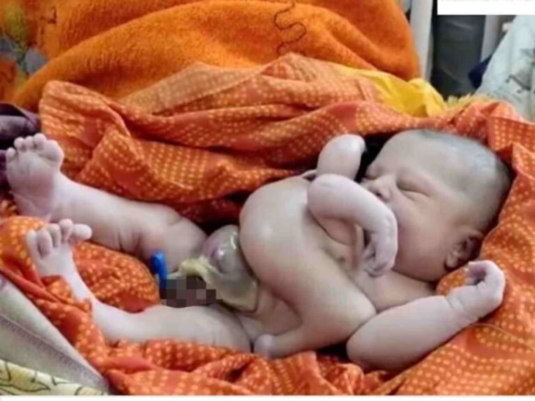 अजब-गजब: यहां महिला ने दिया ‘4 हाथ – 4 पैर’ वाले अद्भुत बच्चे को जन्म (four-legged child)। बना कौतुहल का विषय