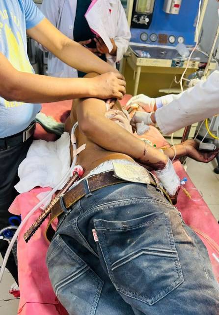 राहत: सीने में आर-पार हुई सरिया, एम्स (AIIMS) के चिकित्सकों ने 18 वर्षीय बचाई युवक की जान